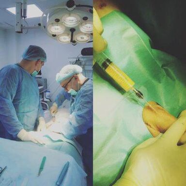 Un ispessimento del pene è possibile con l'aiuto di un'operazione