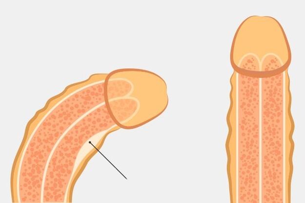 modo efficace per raddrizzare il pene